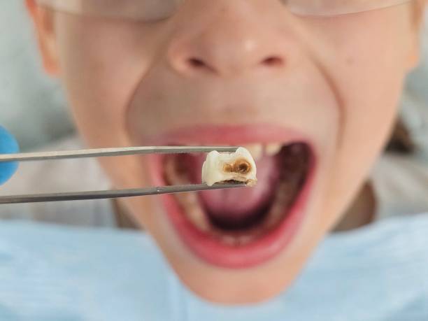 Best Emergency Treatment for Dental Infections or Abscesses in Soldotna, AK